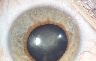 Sindrome Uveitis heterocrómica de Fuchs