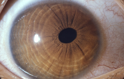 Coloboma