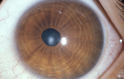 Coloboma