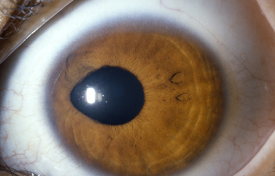 Coloboma