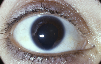 Coloboma