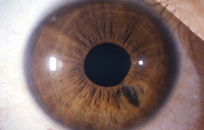 Coloboma