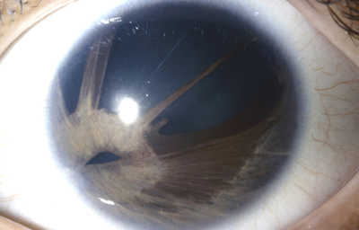 Coloboma