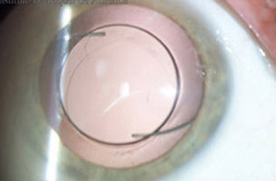 Lente Intraocular