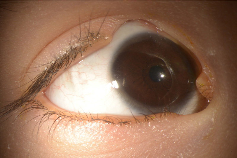 Coloboma