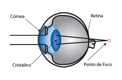 Diagrama Vision Hipermetrópica